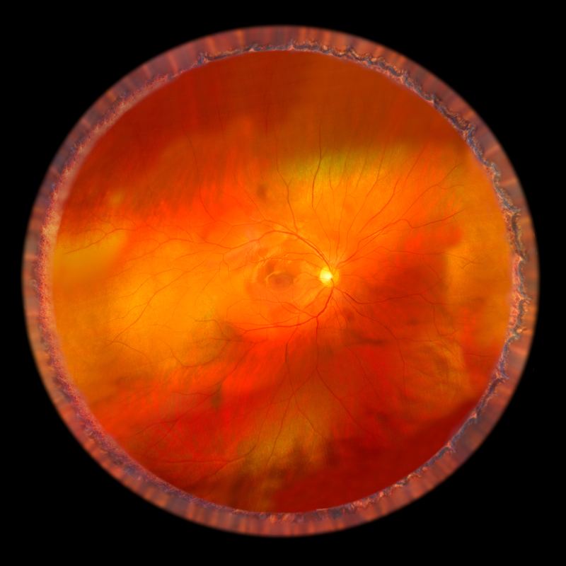 Healthy fundus