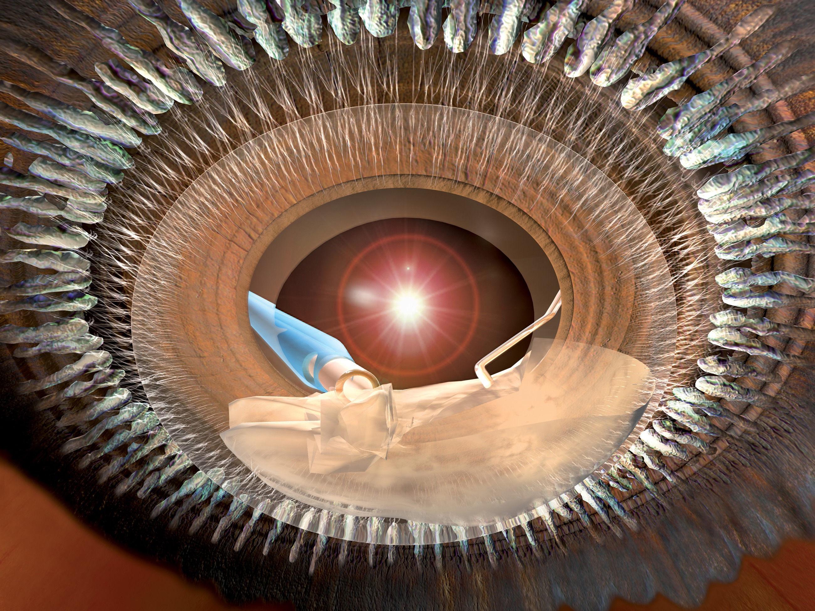 Lens surgery — an internal view