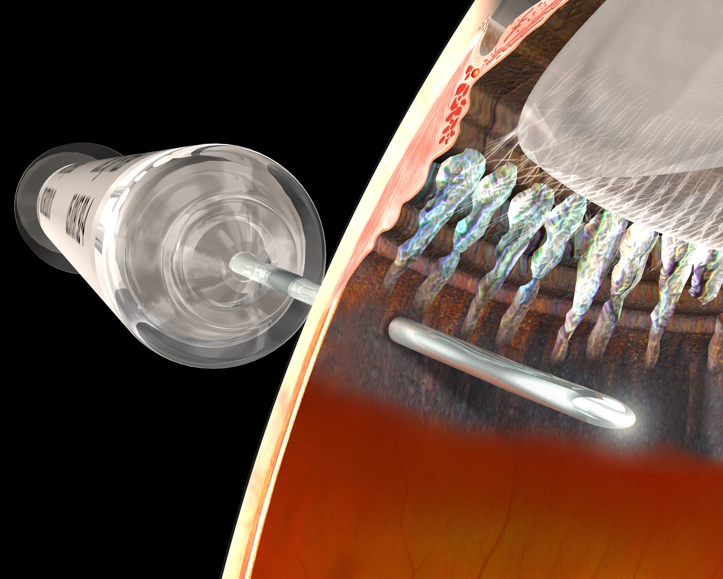 Original Eyeland visualization of lens surgery