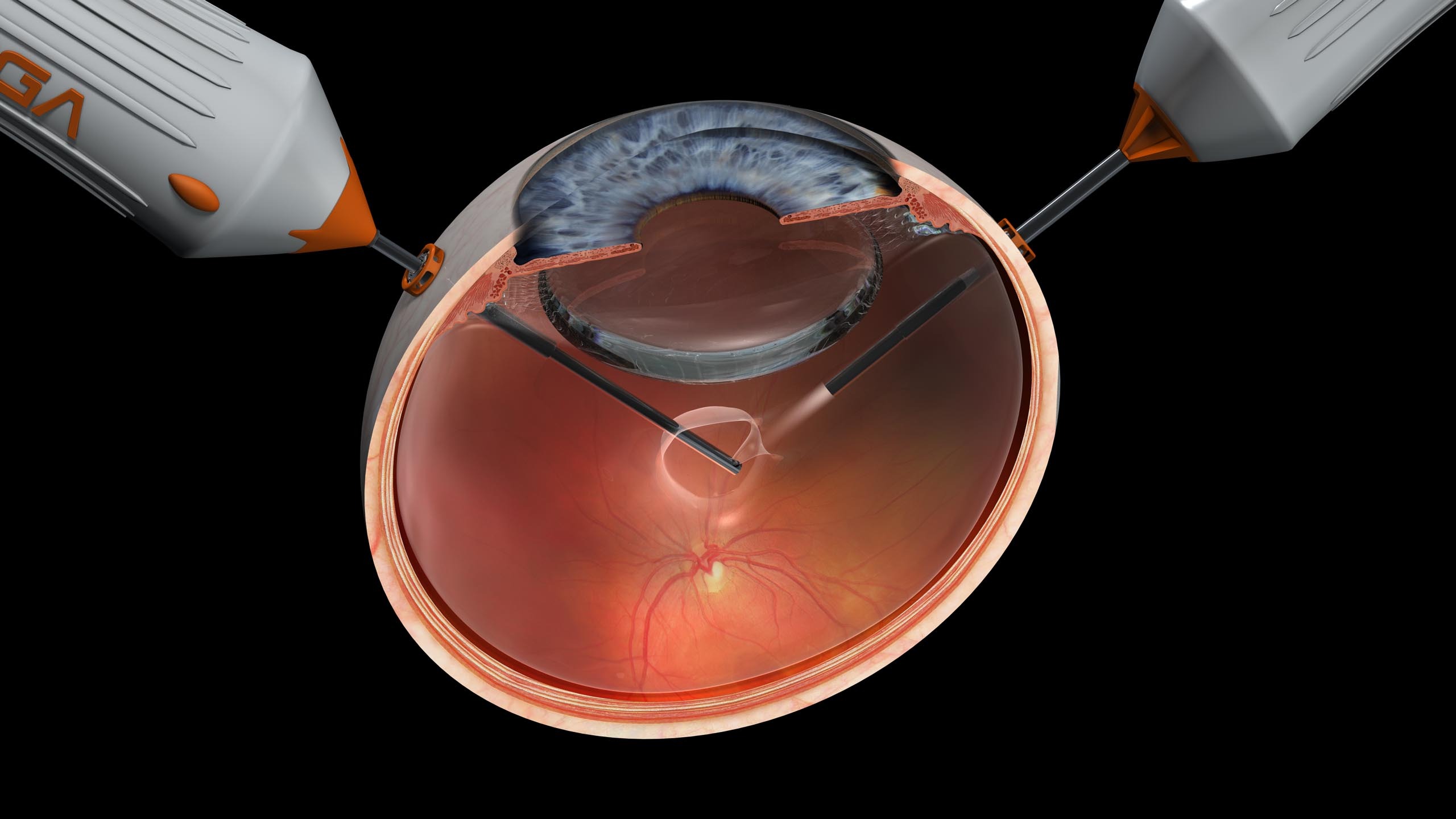 Vitrectomy visualization