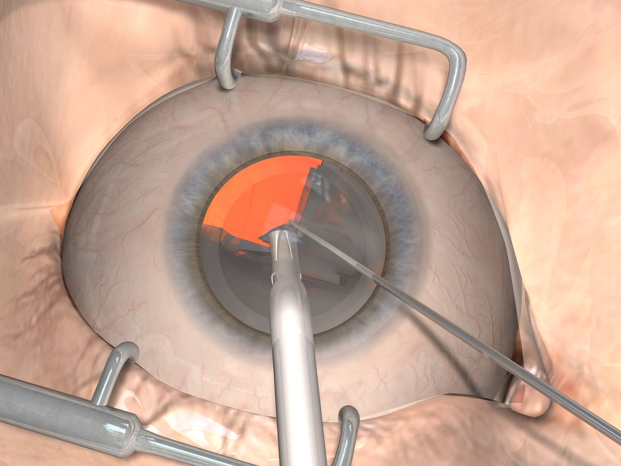 Surgical visualization